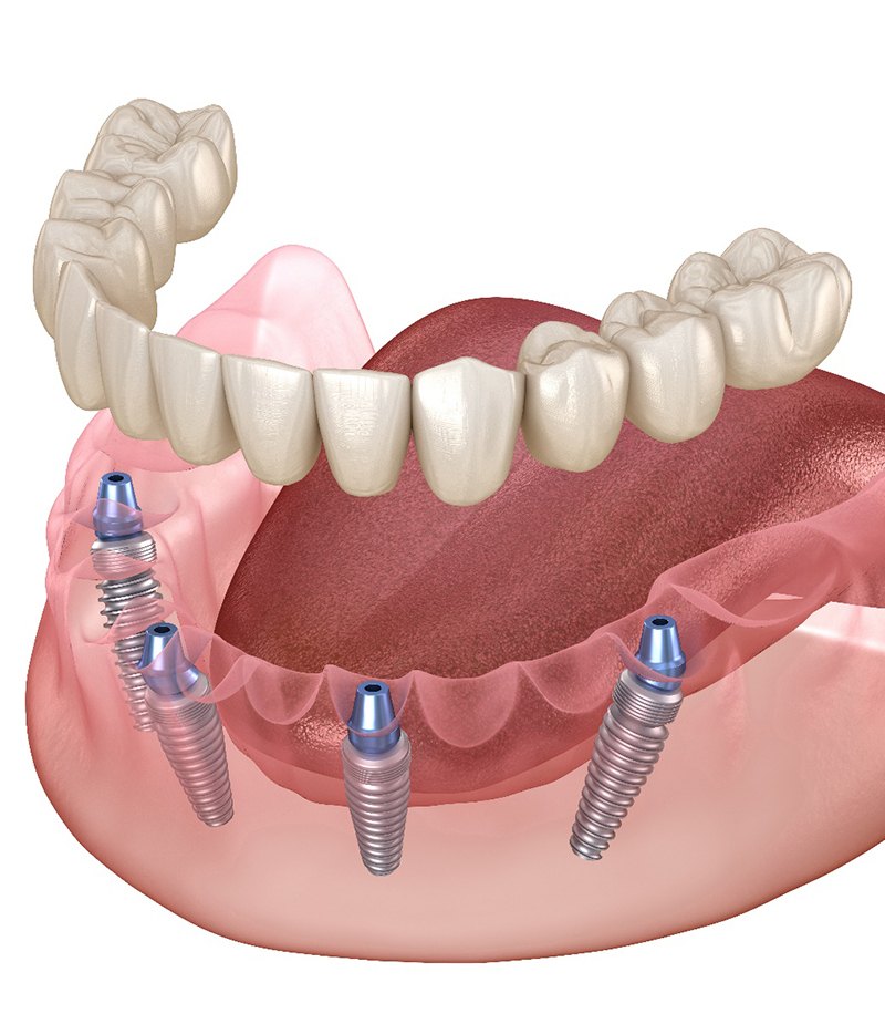 Illustration showing All-on-4 implants for lower arch