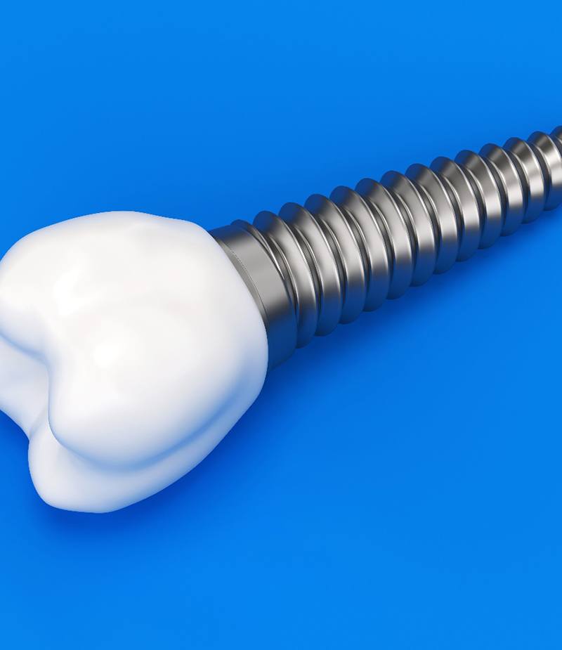 Traditional dental implant and crown against blue background