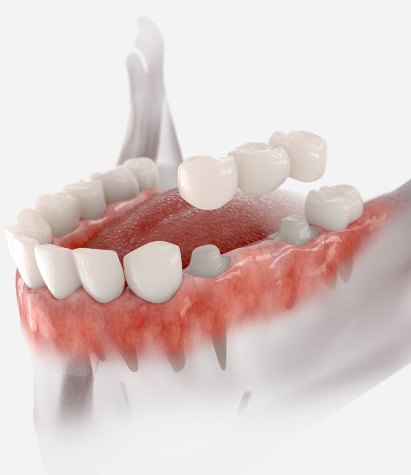 A digital image of a dental bridge
