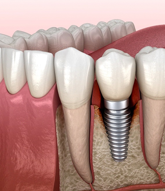 Diagram of a failed dental implant in Panama City