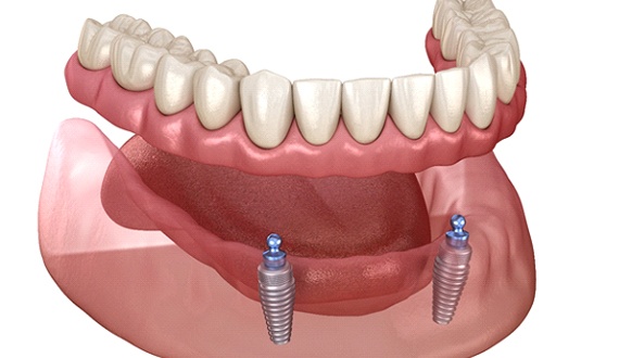 Illustration of implant denture attached by ball sockets