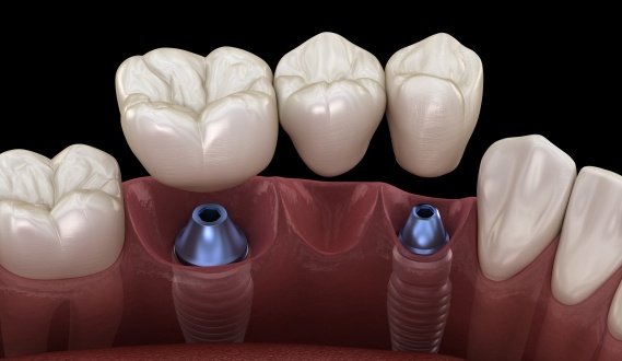 Animated dental implant supported fixed bride placement