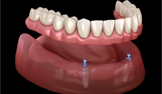 Animated mini dental implant supported denture placement