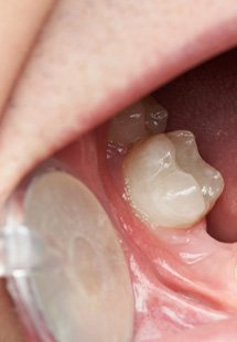 patient with gap in smile 