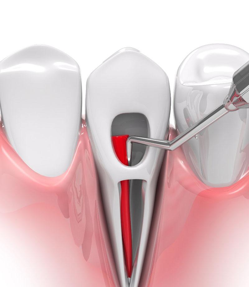 Render of root canal therapy in Panama City, FL for lower teeth