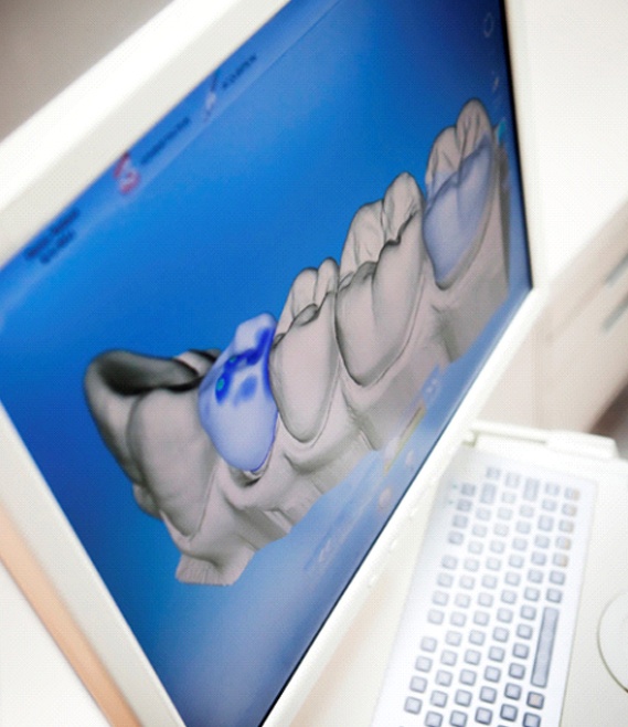 Computer showing digital impression of teeth