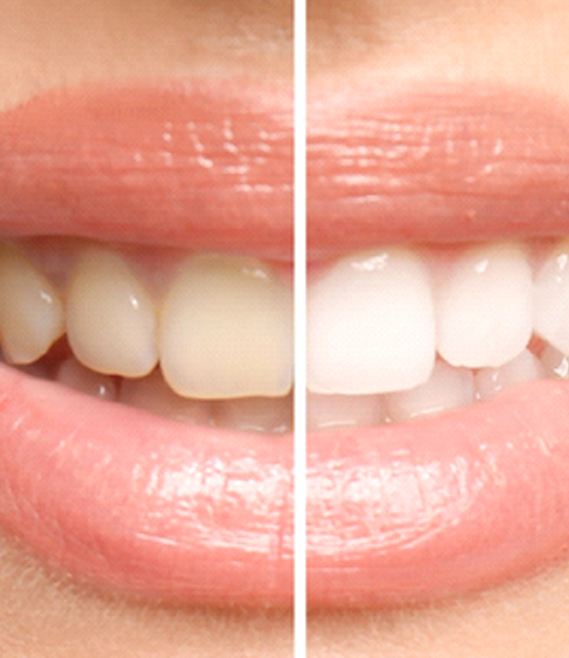 Before and after photo of teeth whitening in Panama City