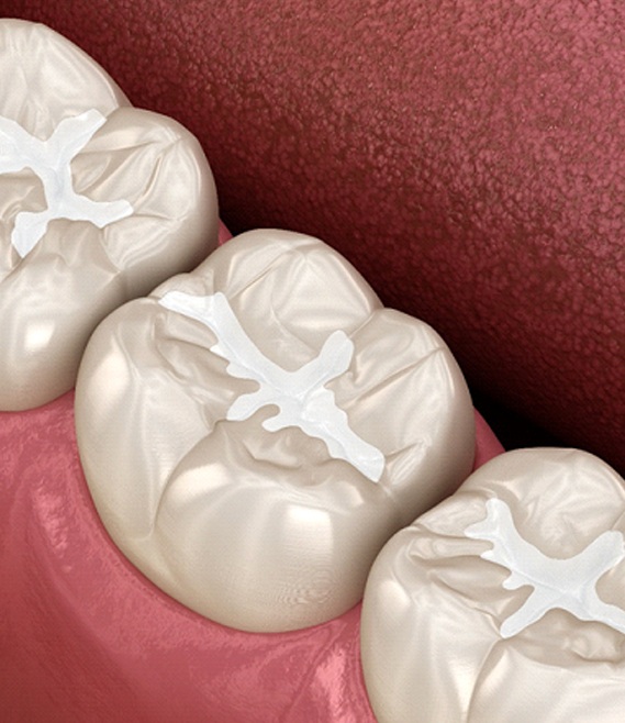 Close-up illustration of tooth-colored fillings in Panama City, FL
