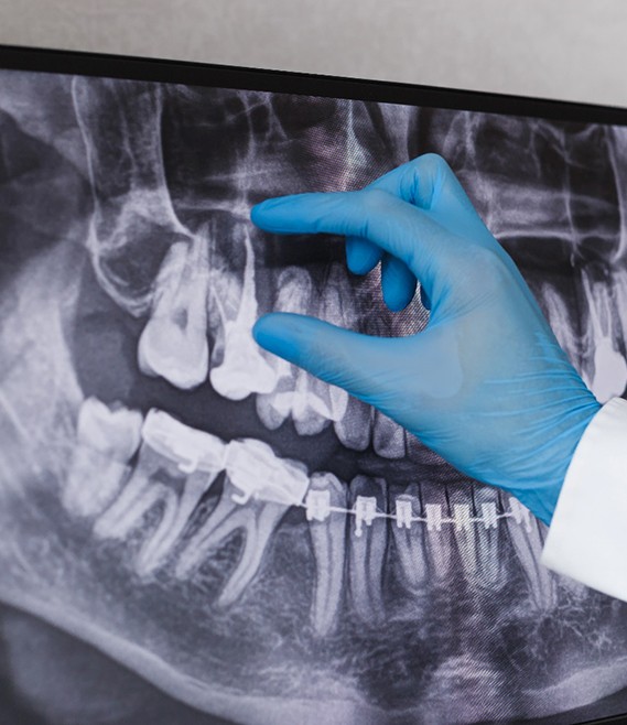 dentist pointing at wisdom teeth in X-ray 