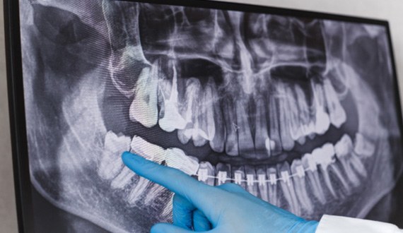 Dentist looking at X-ray of wisdom teeth 