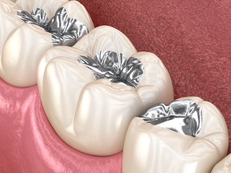 Illustration of three metal amalgam fillings