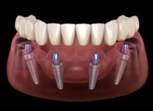 Illustration of implant dentures.