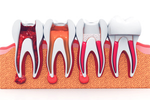 Illustration of the stages of root canal treatment