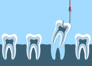 a cartoon image representing a tooth extraction