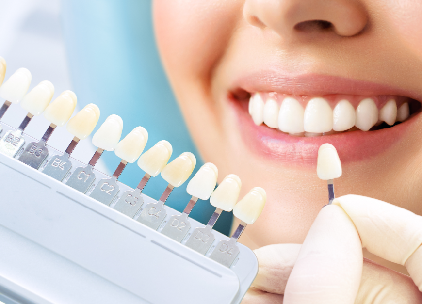 Close up of woman's smile and veneer shades