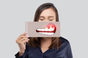 Woman holding up illustration of gum disease over her mouth.