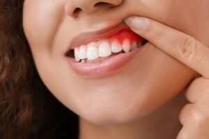 Woman with gum disease